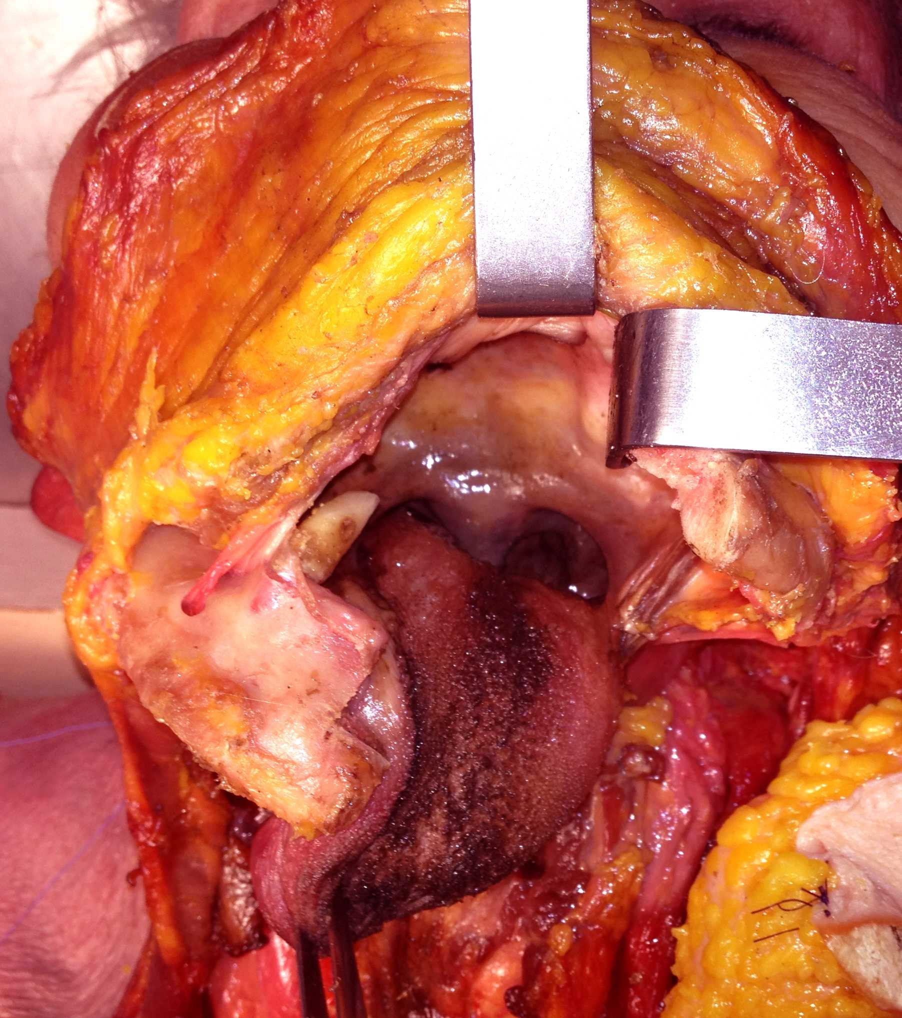 mandibulotomie acces